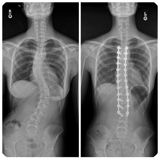 mejora de la curvatura tras el tratamiento proflex