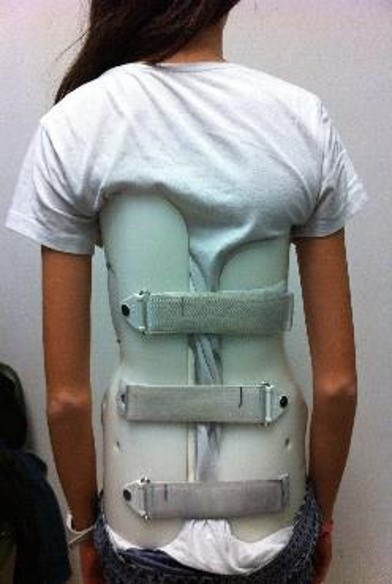 Adolescente con corsé