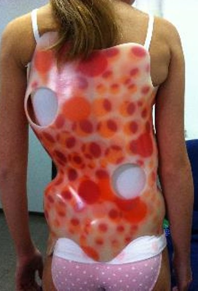 adolescente con corsé para tratar escoliosis